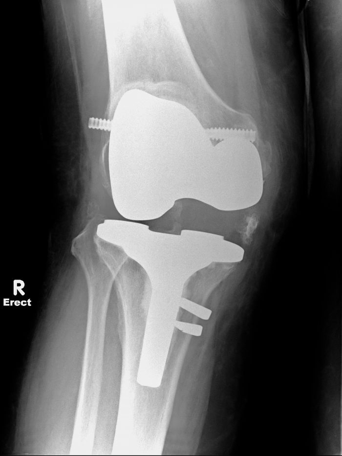 North Coast Orthopaedics | » Revision Knee Replacement